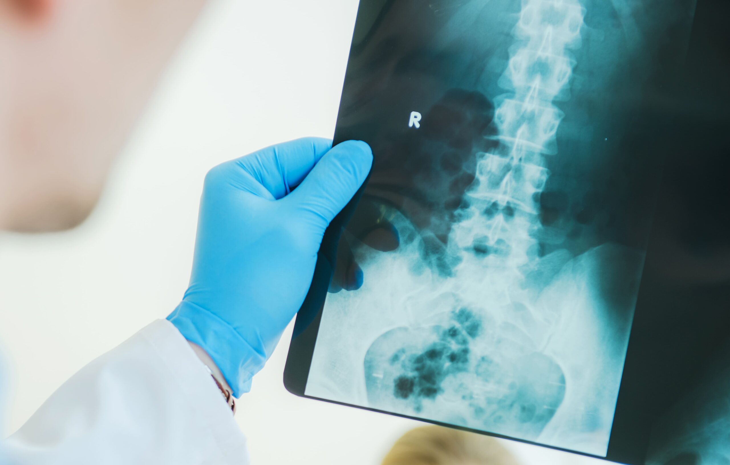 Image arden osteoporosis diagnosis